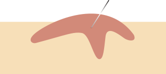 A needle punctures the illustrated Mohs surgery treatment area to deliver a local anesthetic.