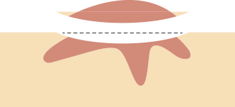 The visible part of the tumor is removed from the surface of the skin and slightly below the surface.